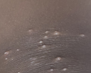 Molluscum contagiosum in black children: understanding prevalence and treatment challenges Close-up of molluscum contagiosum lesions on brown skin showing dome-shaped bumps